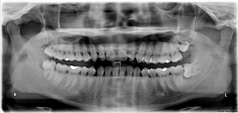 Impacted wisdom teeth.jpg, źródło: Wikimedia commons