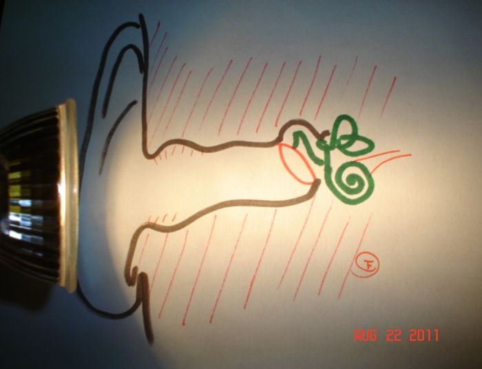 Zapalenie  ucha wewnętrznego.... 