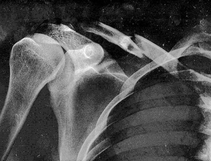 Czym jest osteoporoza i jak ją leczyć?