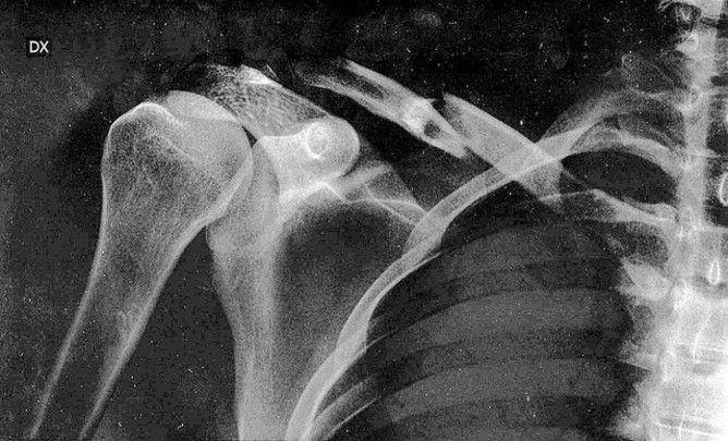 Czym jest osteoporoza i jak ją leczyć?