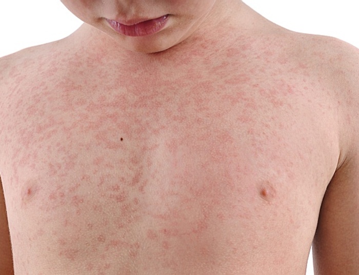 Odra w Warszawie. Rodzice zaczęli zgłaszać się z dziećmi na szczepienia