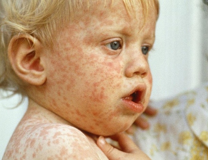 Odra w Mazowieckiem. 10 zachorowań na odrę w Pruszkowie. Wszyscy nie byli szczepieni