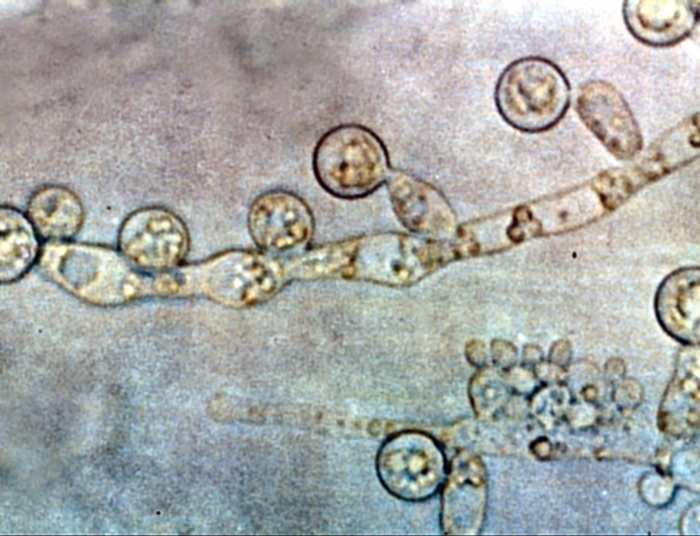 Joe Chal: - Jaki mają związek: grzyb candida, drożdże i pleśni z rakiem?