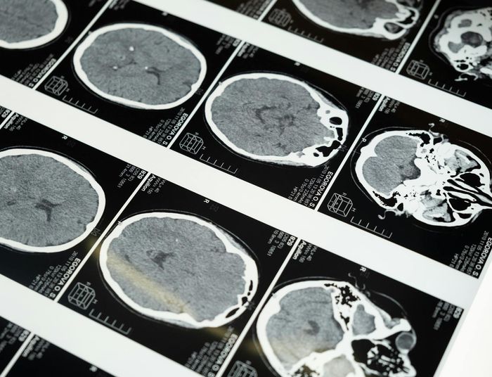 Mózg zmienia się przez całe życie. Nowe odkrycie naukowców