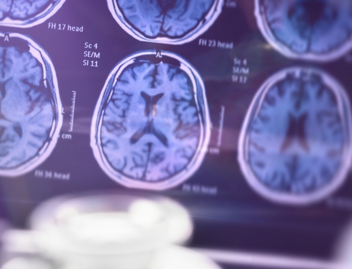 Terapia światłem i dźwiękiem. Nowatorska metoda leczenia Alzheimera