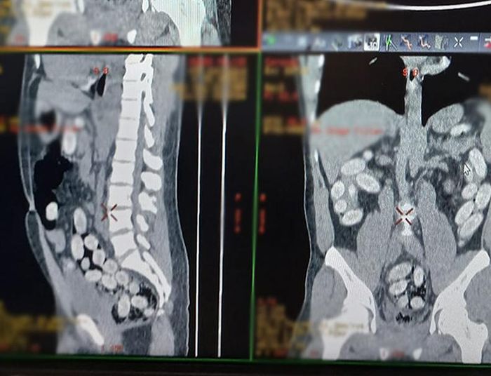 Narkotyki w brzuchu - to nie żart. Takie cuda odkrywa KAS